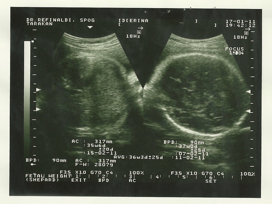 Gambar Usg Dasar Kehamilan 15 10 Minggu 16 Gambar Janin 13 